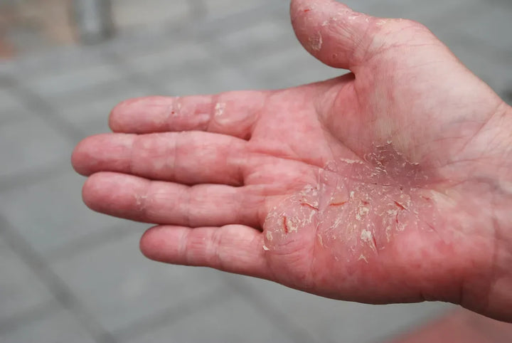 Psoriasis and the Itch: Treating It With Herbal Medicine